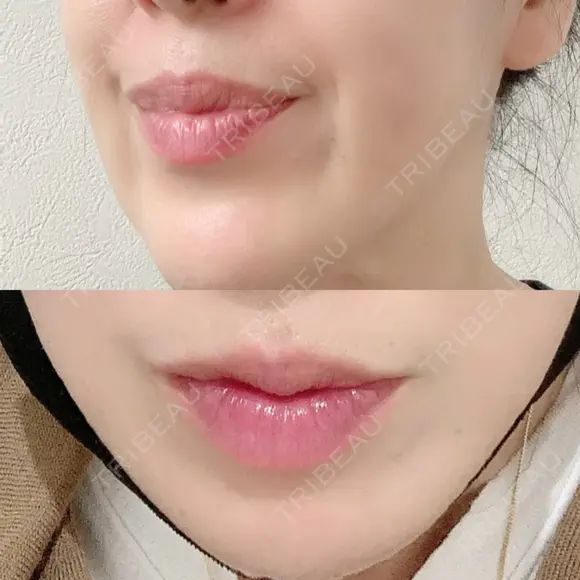 シワ取りボトックス 湘南美容クリニック 藤沢院 DAY 14 メイン用