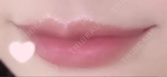 ヒアルロン酸注入（唇） / ボトックス（口角） フィラークリニック 大阪心斎橋院 AFTER メイン用