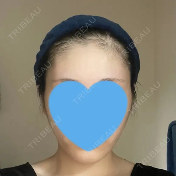 糸リフト / 脂肪吸引（顔） 銀座マイアミ美容外科 DAY 120 メイン用