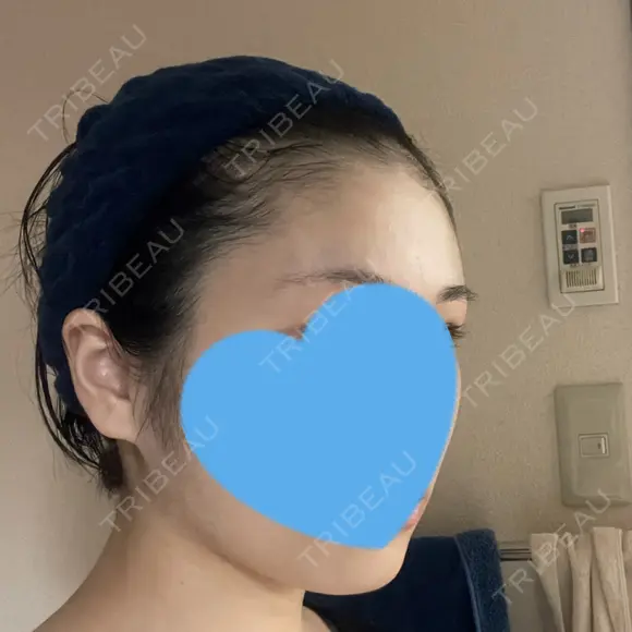 糸リフト / 脂肪吸引（顔） 銀座マイアミ美容外科 DAY 120 メイン用