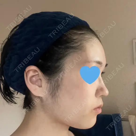 糸リフト / 脂肪吸引（顔） 銀座マイアミ美容外科 DAY 120 メイン用