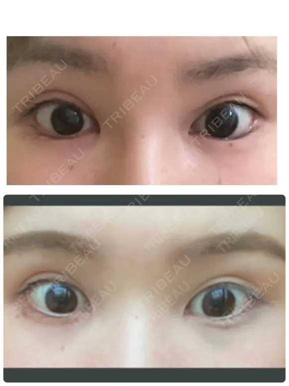 目尻切開 / タレ目形成・グラマラスライン（切開） ビスポーククリニック 福岡院 AFTER メイン用