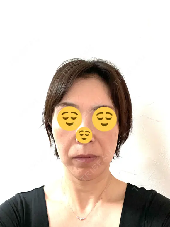 プラセンタ注射 / ハイフ（顔） 心斎橋藤井クリニック DAY 1 メイン用