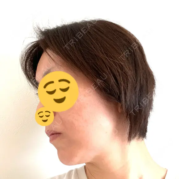 プラセンタ注射 / ハイフ（顔） 心斎橋藤井クリニック DAY 1 メイン用