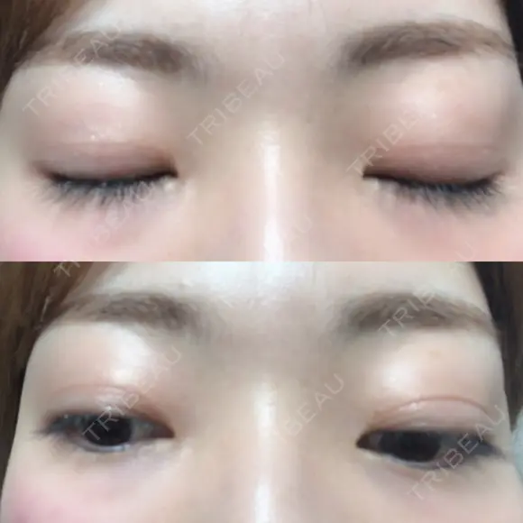 二重切開 松下皮フ形成外科 DAY 77 メイン用