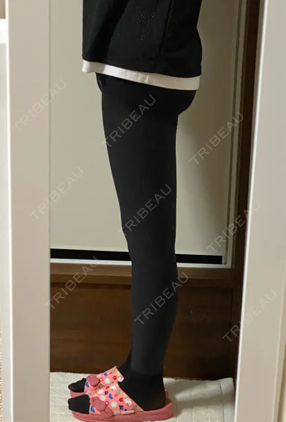 糸リフト / 脂肪吸引（顔） / 脂肪吸引（脚） / 脂肪吸引（お尻） 湘南美容クリニック 札幌院 DAY 17 メイン用