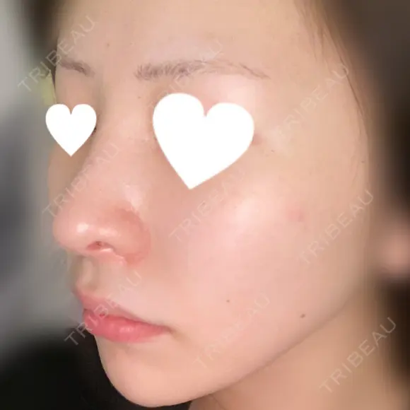 隆鼻術 / 鼻尖形成（切開） / 鼻中隔延長（切開） / 小鼻縮小（切開） / 軟骨移植 / 眉間プロテーゼ / ヒアルロン酸注入（鼻） KAUNIS CLINIC（カウニスクリニック） AFTER メイン用