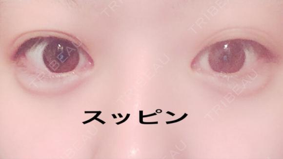 ヒアルロン酸注入（涙袋） しのぶ皮膚科 AFTER メイン用