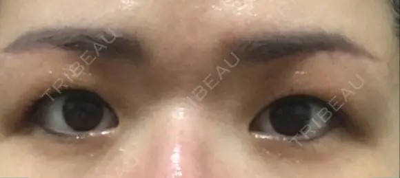 眉下切開 湘南美容クリニック 大阪京橋院 DAY 68 メイン用