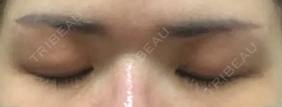 眉下切開 湘南美容クリニック 大阪京橋院 DAY 68 メイン用