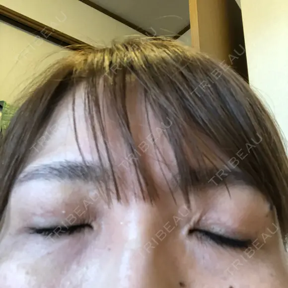 二重切開 / 眼瞼下垂（切開） / 上まぶたたるみ取り 湘南美容クリニック 高田馬場院 AFTER メイン用