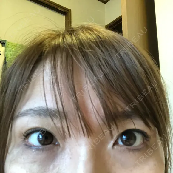 二重切開 / 眼瞼下垂（切開） / 上まぶたたるみ取り 湘南美容クリニック 高田馬場院 DAY 201 メイン用