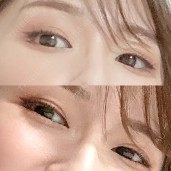 二重切開 松下皮フ形成外科 DAY 129 メイン用