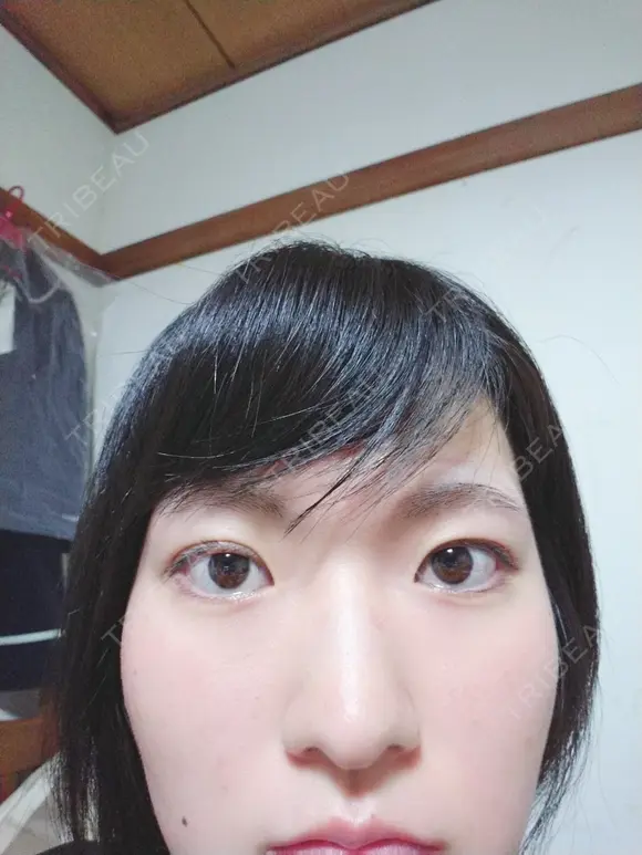 二重埋没 共立美容外科 札幌院 DAY 145 メイン用