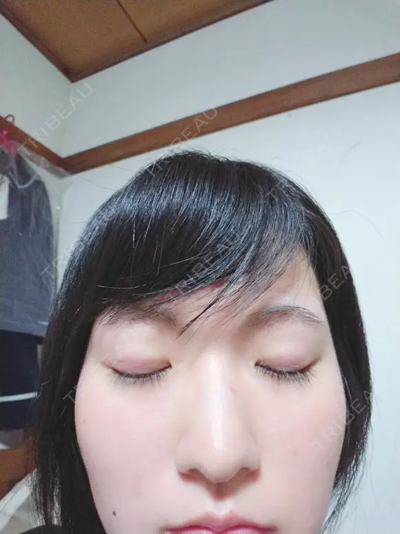 二重埋没 共立美容外科 札幌院 DAY 145 メイン用