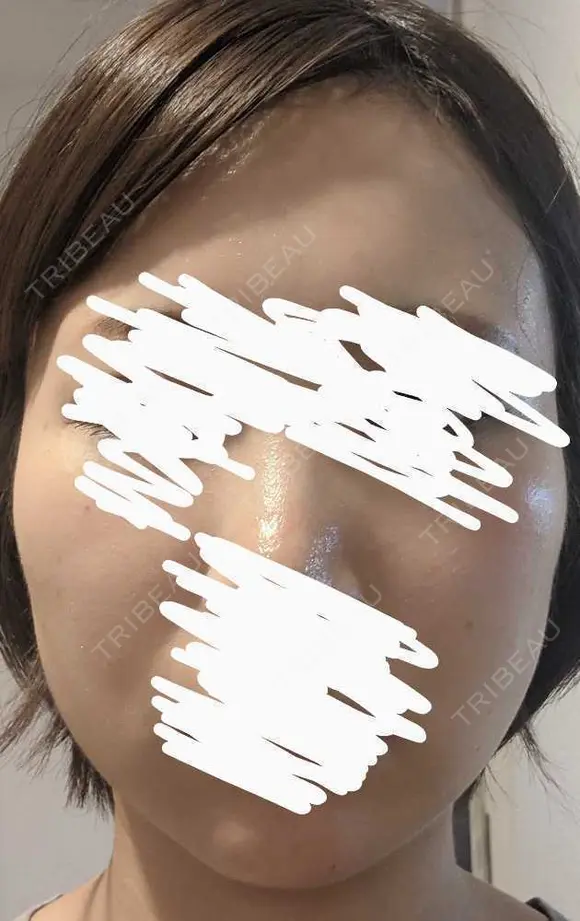 ボトックス（エラ・小顔） 湘南美容クリニック 静岡院 DAY 5 メイン用