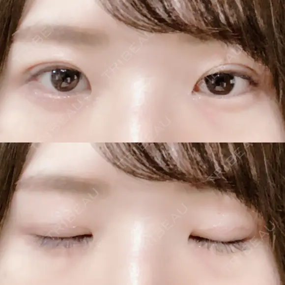 二重切開 松下皮フ形成外科 DAY 15 メイン用