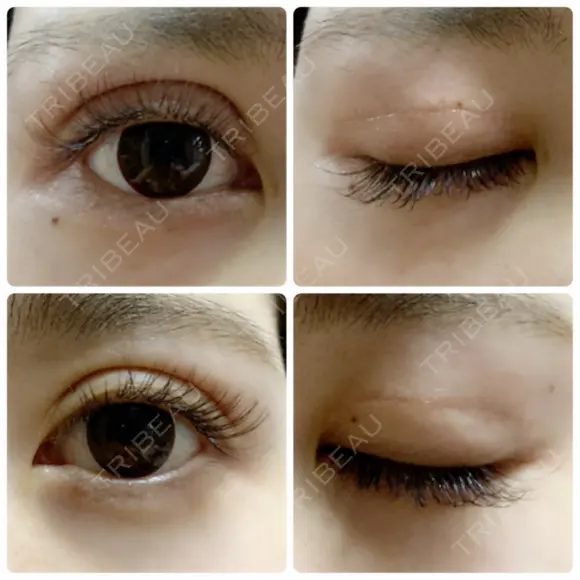 二重切開 / 上まぶたたるみ取り 城本クリニック 姫路院 DAY 51 メイン用