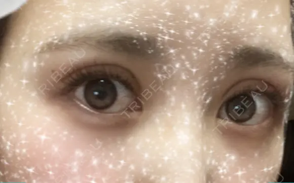 二重切開 / 上まぶたたるみ取り 城本クリニック 姫路院 DAY 51 メイン用