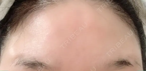 額を丸く / シワ取りボトックス / その他（肌） / その他（輪郭） 湘南美容クリニック 藤沢院 DAY 23 メイン用