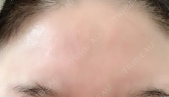 額を丸く / シワ取りボトックス / その他（肌） / その他（輪郭） 湘南美容クリニック 藤沢院 DAY 23 メイン用