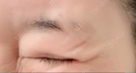 シワ取りボトックス 湘南美容クリニック 藤沢院 DAY 23 メイン用