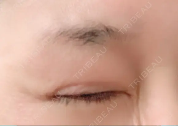 シワ取りボトックス 湘南美容クリニック 藤沢院 DAY 23 メイン用