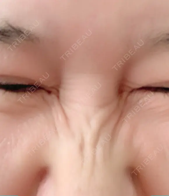 シワ取りボトックス 湘南美容クリニック 藤沢院 DAY 23 メイン用