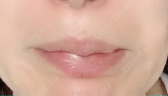 シワ取りボトックス 湘南美容クリニック 藤沢院 DAY 12 メイン用