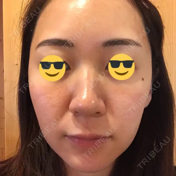 ダーマペン AURORA CLINIC（オーロラクリニック）新宿院 DAY 3 メイン用