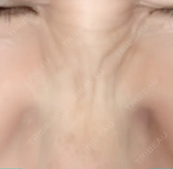 シワ取りボトックス 湘南美容クリニック 藤沢院 DAY 12 メイン用