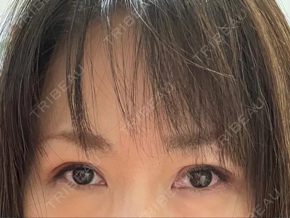 二重切開 / 上まぶたたるみ取り / 上まぶたの脂肪取り 松下皮フ形成外科 DAY 46 メイン用