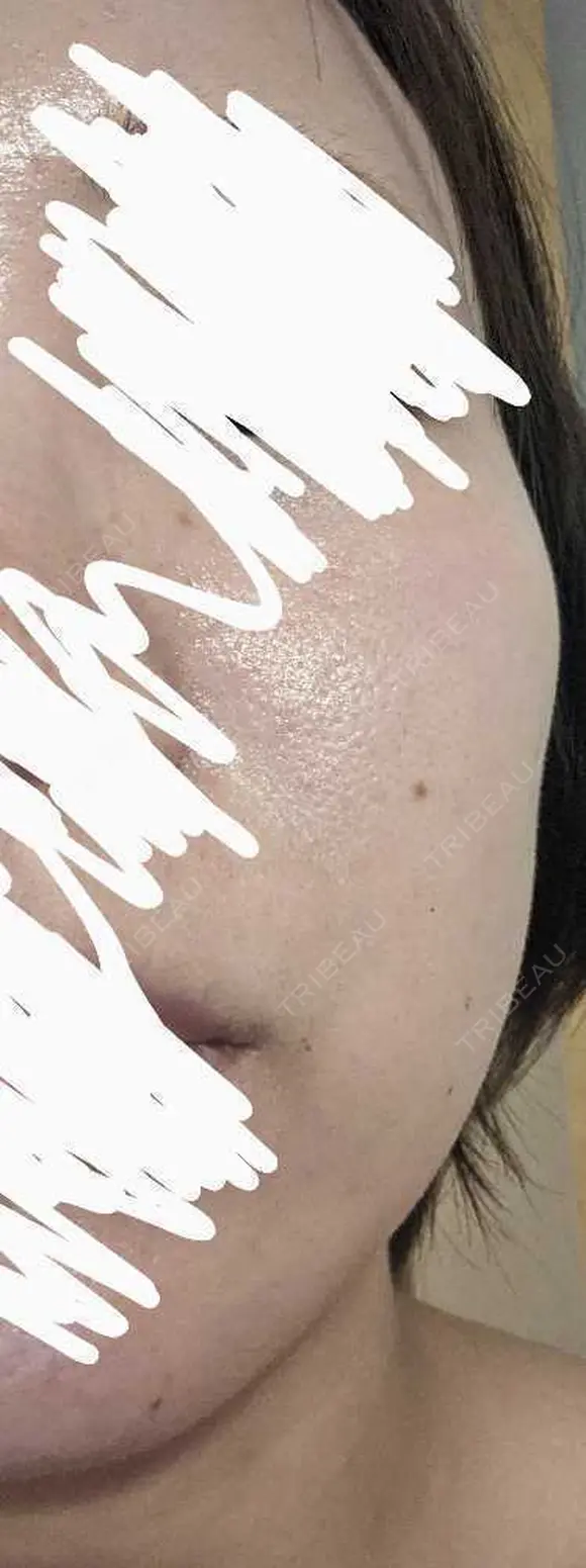 ボトックス（エラ・小顔） 湘南美容クリニック 静岡院 DAY 8 メイン用