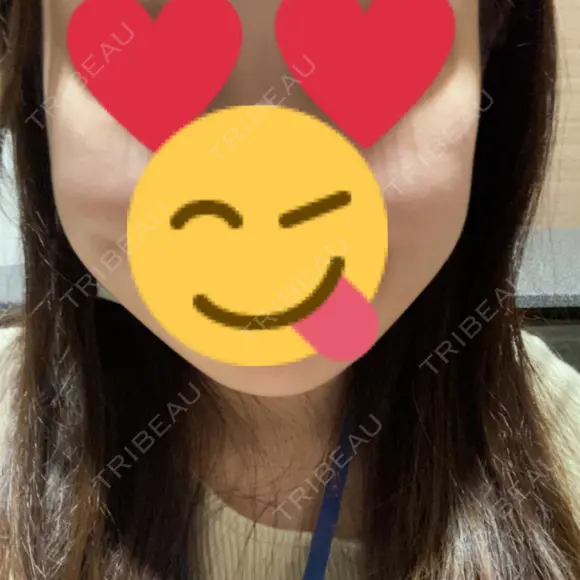 ボトックス（エラ・小顔） 湘南美容クリニック 武蔵小杉院 DAY 3 メイン用