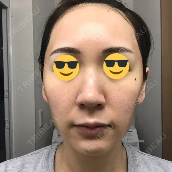 ダーマペン AURORA CLINIC（オーロラクリニック）新宿院 DAY 4 メイン用