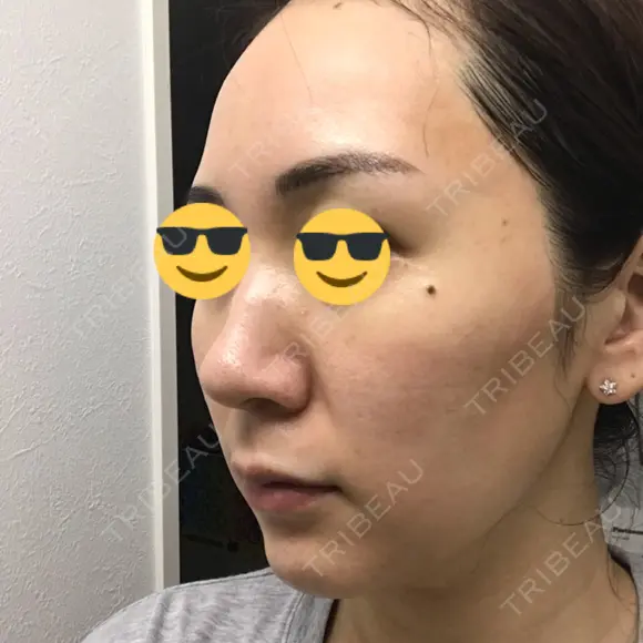 ダーマペン AURORA CLINIC（オーロラクリニック）新宿院 DAY 4 メイン用