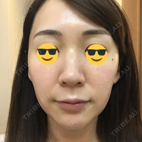 ダーマペン AURORA CLINIC（オーロラクリニック）新宿院 DAY 5 メイン用