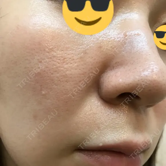 ダーマペン AURORA CLINIC（オーロラクリニック）新宿院 DAY 5 メイン用