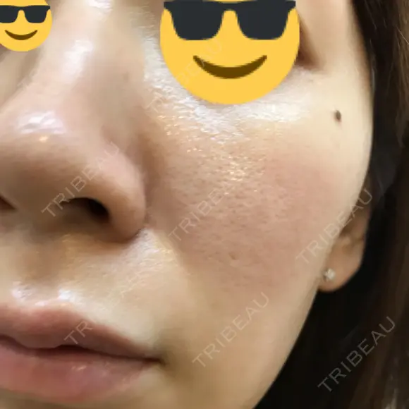 ダーマペン AURORA CLINIC（オーロラクリニック）新宿院 DAY 5 メイン用