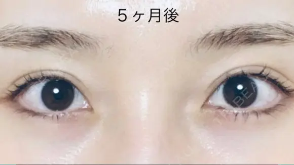 二重切開 / 上まぶたたるみ取り R.O.clinic DAY 150 メイン用