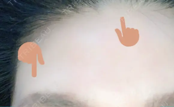 額を丸く / シワ取りボトックス / その他（肌） / その他（輪郭） 湘南美容クリニック 藤沢院 DAY 26 メイン用