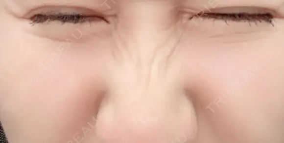 シワ取りボトックス 湘南美容クリニック 藤沢院 DAY 26 メイン用