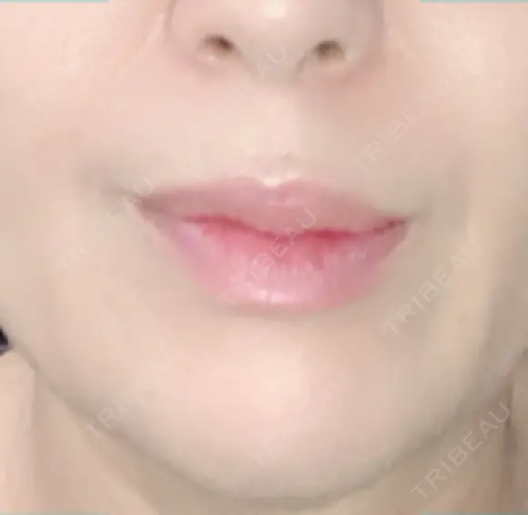 シワ取りボトックス 湘南美容クリニック 藤沢院 DAY 26 メイン用