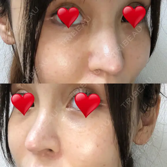 隆鼻術 / 鼻尖形成（切開） / 鼻中隔延長（切開） / 軟骨移植 / プロテーゼ除去 / 鼻修正 THE ROPPONGI CLINIC（ザ 六本木クリニック） DAY 92 メイン用