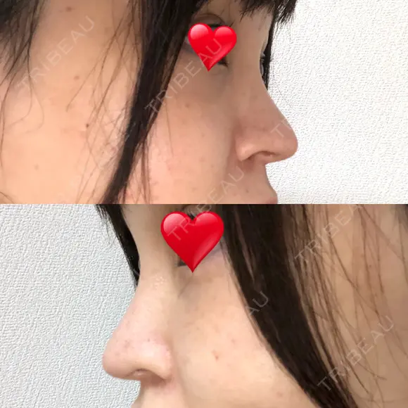 隆鼻術 / 鼻尖形成（切開） / 鼻中隔延長（切開） / 軟骨移植 / プロテーゼ除去 / 鼻修正 THE ROPPONGI CLINIC（ザ 六本木クリニック） DAY 92 メイン用