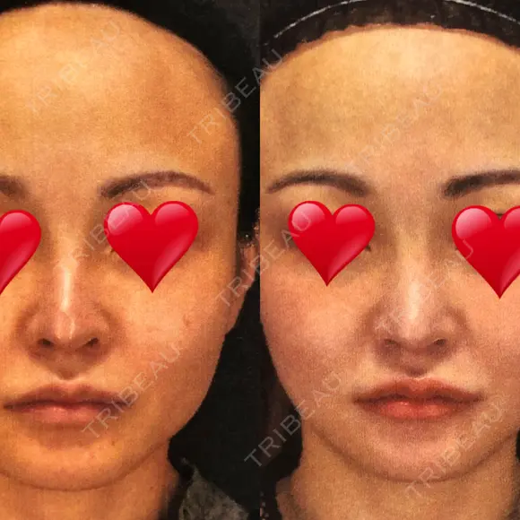 隆鼻術 / 鼻尖形成（切開） / 鼻中隔延長（切開） / 軟骨移植 / プロテーゼ除去 / 鼻修正 THE ROPPONGI CLINIC（ザ 六本木クリニック） AFTER メイン用