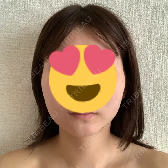 糸リフト / 脂肪吸引（顔） 湘南美容クリニック 大阪心斎橋院 DAY 44 メイン用