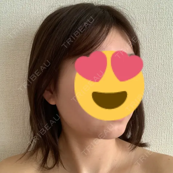 糸リフト / 脂肪吸引（顔） 湘南美容クリニック 大阪心斎橋院 DAY 44 メイン用