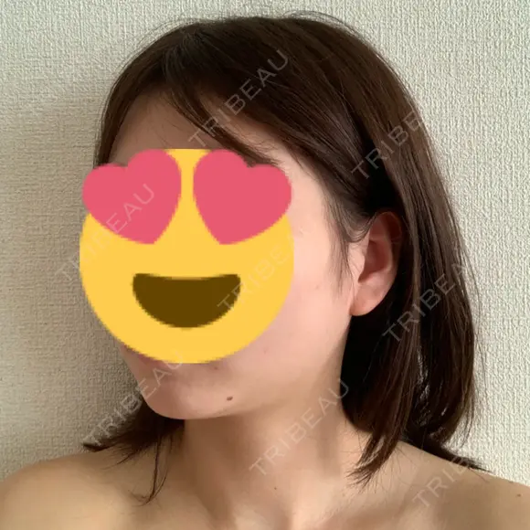 糸リフト / 脂肪吸引（顔） 湘南美容クリニック 大阪心斎橋院 DAY 44 メイン用