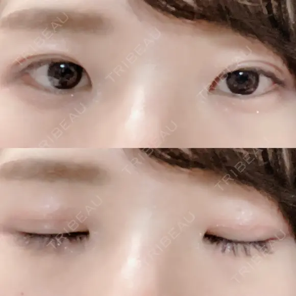 二重切開 松下皮フ形成外科 DAY 22 メイン用